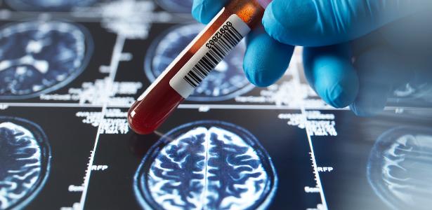 Novo exame de sangue para detectar Alzheimer chega ao Brasil