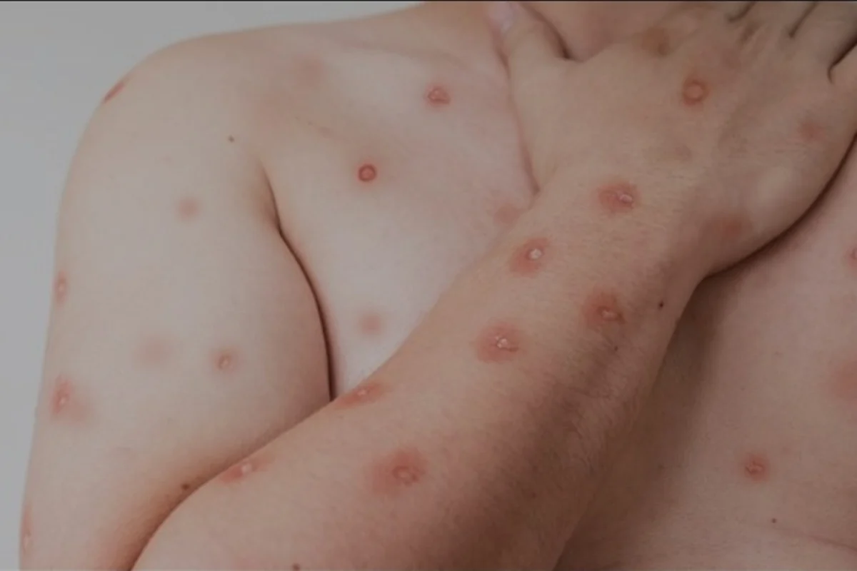 Saiba como ocorre a transmissão do vírus da Mpox