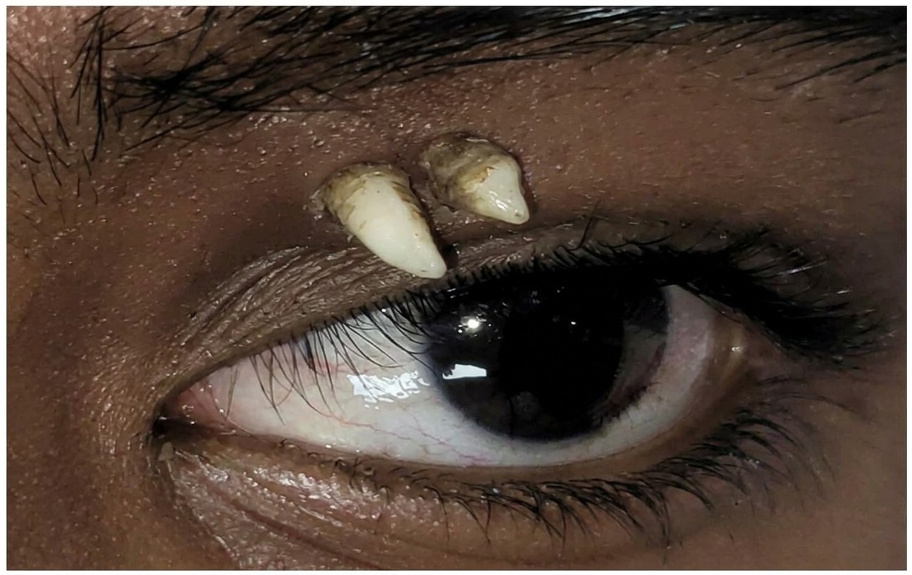 Adolescente passa por cirurgia após dente crescer entre olho e sobrancelha