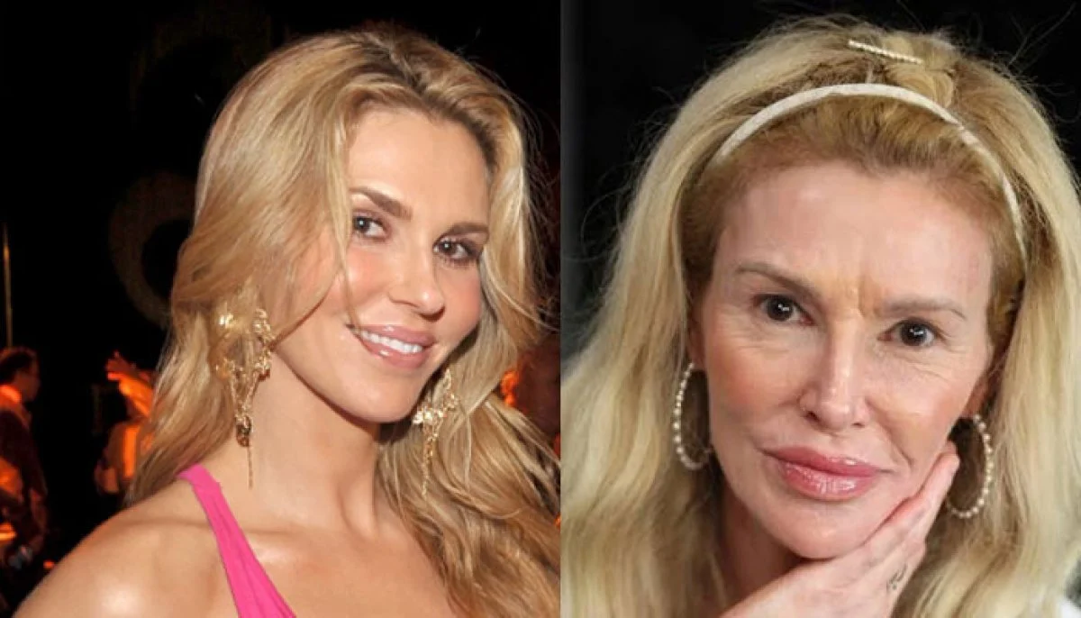 Brandi Glanville relata preparação para cirurgia facial complexa