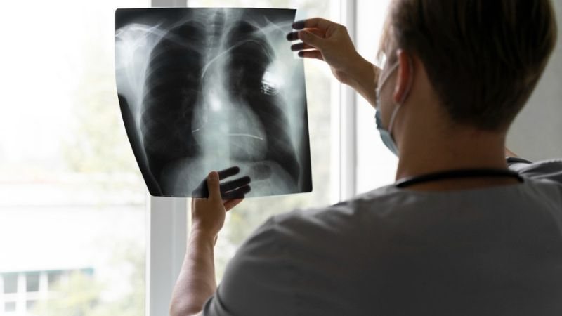 Anvisa aprova novo medicamento para tratamento de câncer de pulmão avançado