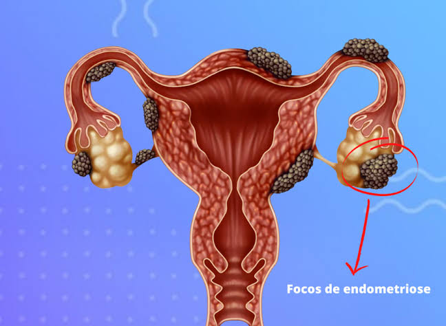 Cirurgia da endometriose evolui com foco em precisão e preservação