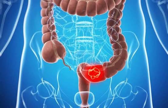 Câncer de intestino: prevenção, exames e sinais de alerta